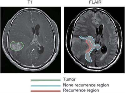 Frontiers MRI Radiomic Features Of Peritumoral Edema May Predict The